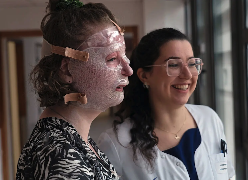 3D Printing Produces Face Masks for Treating Severely Burned Children