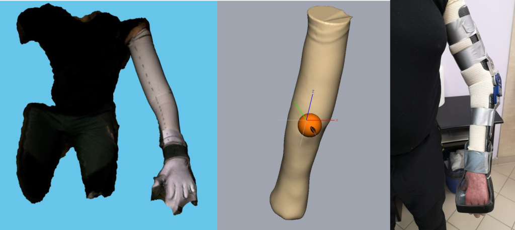 Orthotic for a brachial plexus injury: A 3D scan was processed in Freeform and used to mill a positive model.